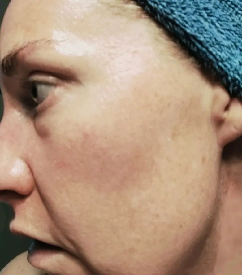 Rebecca — BodyMatched before and after, reduced wrinkles and smoother skin