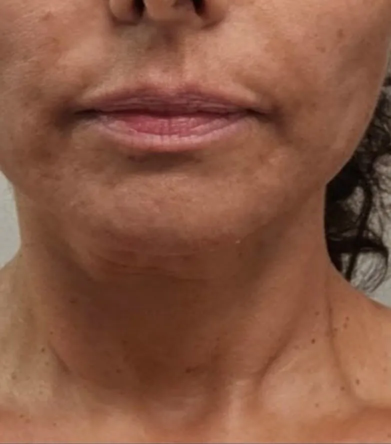 Verified patient — BodyMatched before and after, plumper skin, fewer neck lines