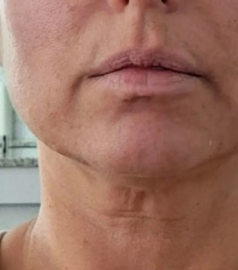 Verified patient — BodyMatched before and after, plumper skin, fewer neck lines