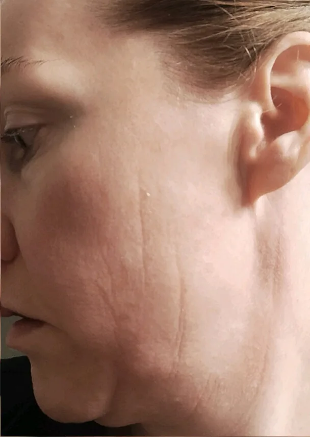 Rebecca — BodyMatched before and after, reduced wrinkles and smoother skin