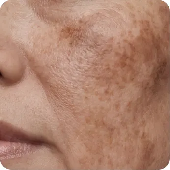 Dark spots + texture