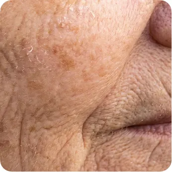 Fine lines + wrinkles