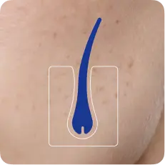 Follicle sensitivity