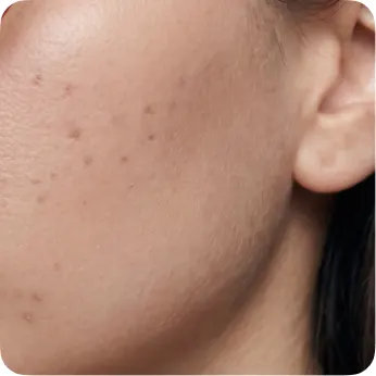 Hormonal acne