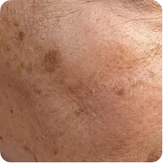 Dark spots + uneven tone