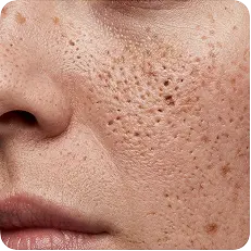 Enlarged pores + rough texture