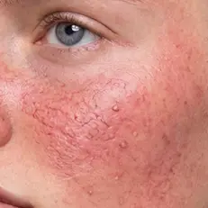 Skin barrier + redness