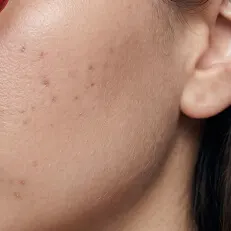 Reduces hyperpigmentation + acne