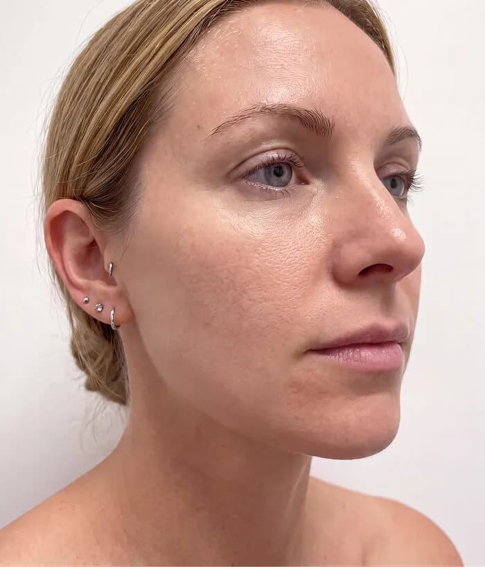 Michelle, age 32 — BodyMatched before and after, reduced facial hair