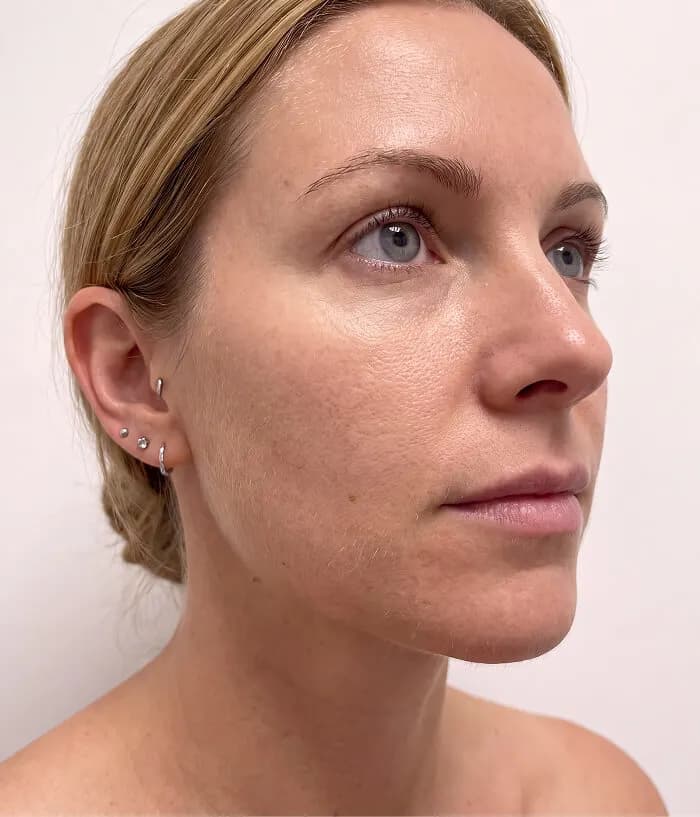 Verified patient — BodyMatched before and after, plumper skin, fewer neck lines